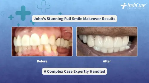 Before and after image of John's mouth showing the successful results of his complex dental implants and full smile makeover in India, transforming damaged teeth into a healthy, brilliant smile